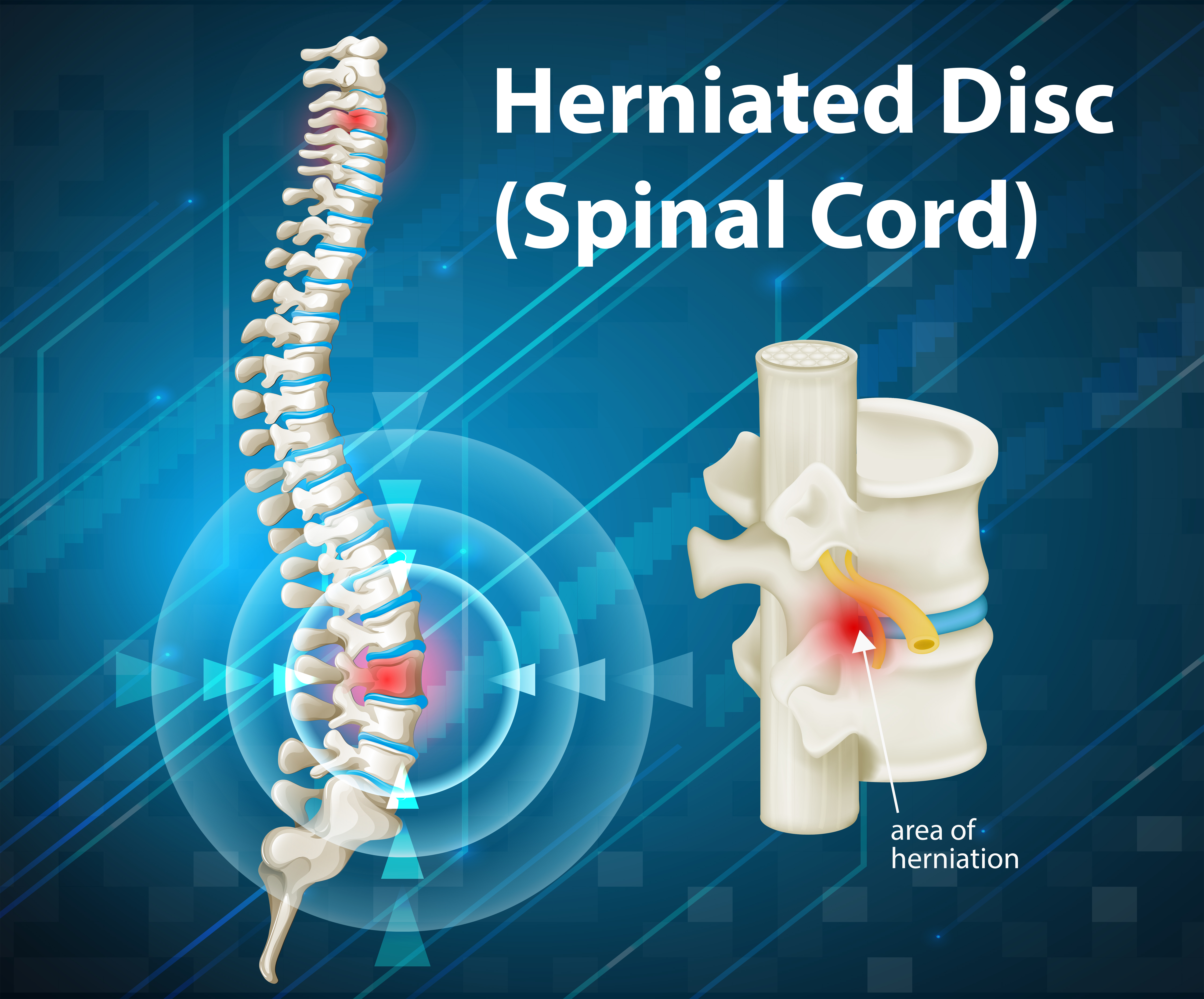 Herniated Discs