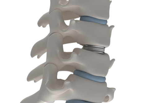 cervical disc replacement