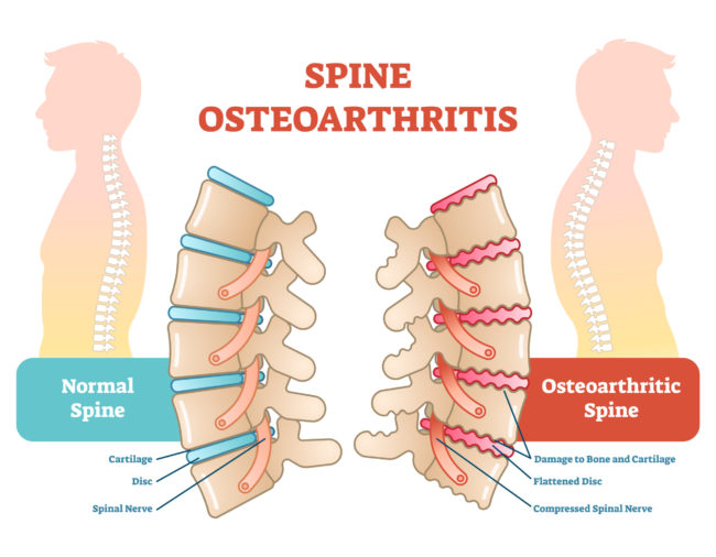 What is Osteoarthritis, and how does it affect my spine?