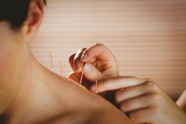 Young,Woman,Getting,Acupuncture,Treatment,In,Therapy,Room Acupuncture for Chronic Stiff Neck