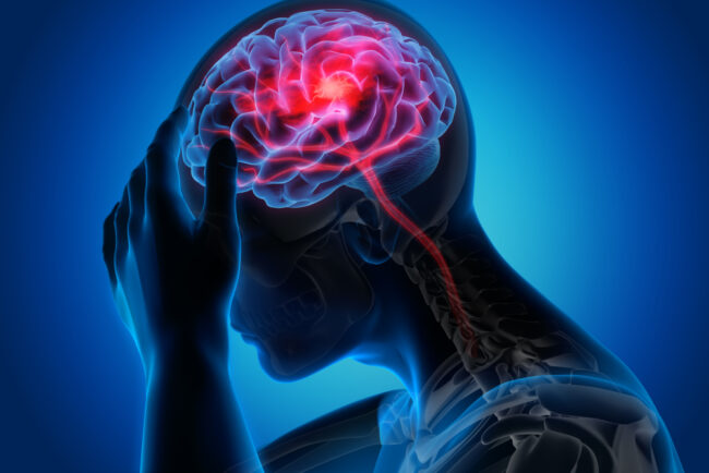 Man,With,A,Headache,-,Stroke,-3d,Illustration 6 Surprising Reasons For A Headache