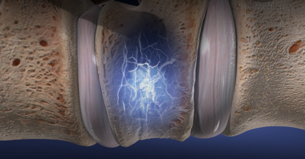 Vertebroplasty: A Beacon of Hope in Spinal Fracture Treatment