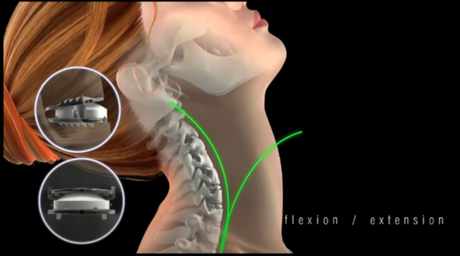 Symmetry Disc for Cervical Spine Replacement