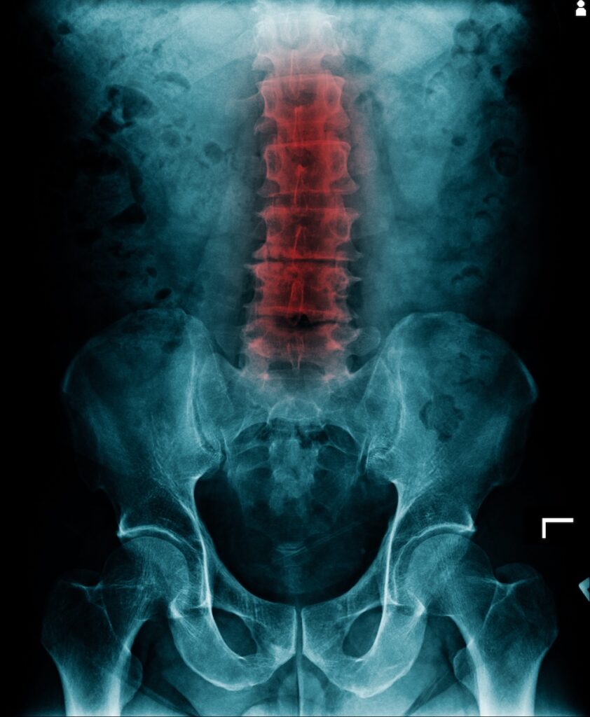 How to Prevent Degenerative Disc Disease