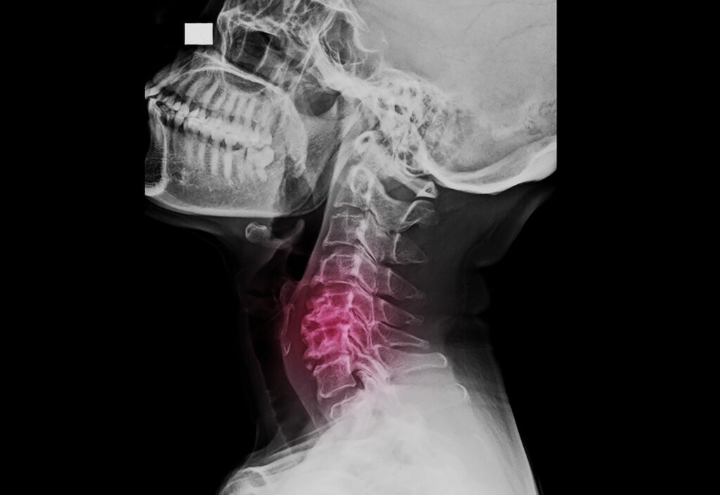 Preparing for Posterior-Lateral Spinal Fusion (PSF)
