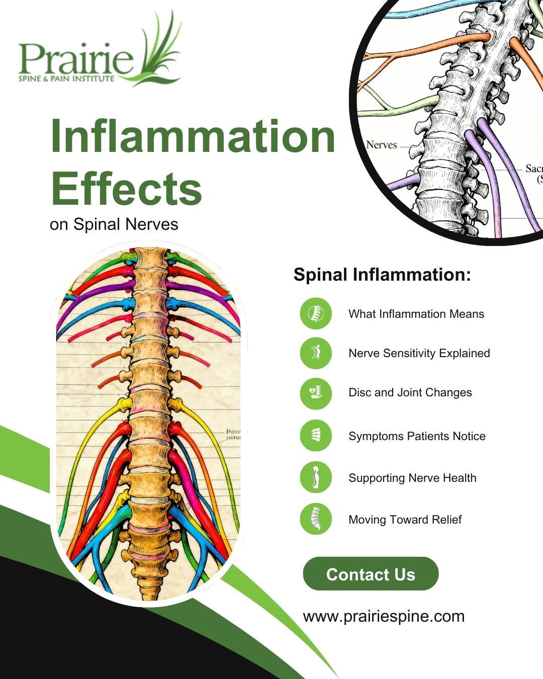 Inflammation Effects on Spinal Nerves