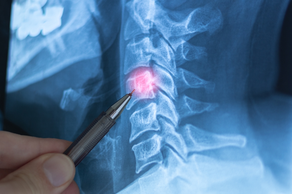 The Science of Spinal Disc Health and Care